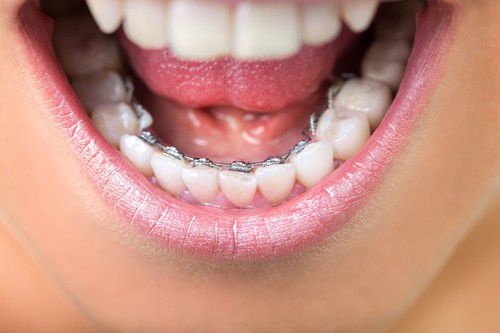 phương pháp niềng răng hiệu quả ảnh 3 phuong phap nieng rang hieu qua anh 3