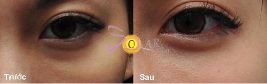 xóa thâm quầng mắt sau 1 lần điều trị ảnh 2 xoa tham quang mat sau 1 lan dieu tri anh 2