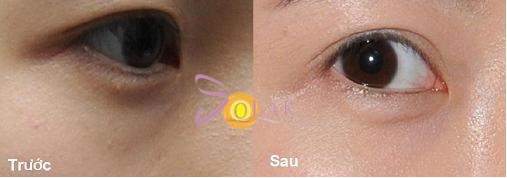 xóa thâm quầng mắt sau 1 lần điều trị ảnh 3 xoa tham quang mat sau 1 lan dieu tri anh 3