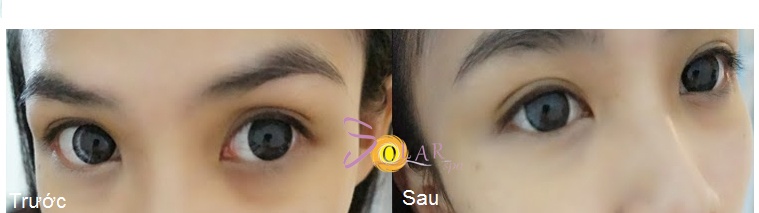 xóa thâm quầng mắt sau 1 lần điều trị ảnh 5 xoa tham quang mat sau 1 lan dieu tri anh 5