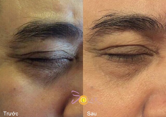 xóa thâm quầng mắt sau 1 lần điều trị ảnh 4 xoa tham quang mat sau 1 lan dieu tri anh 4
