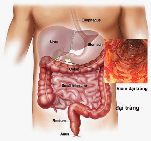 trị dứt điểm viêm đại tràng ảnh 1 tri dut diem viem dai trang anh 1
