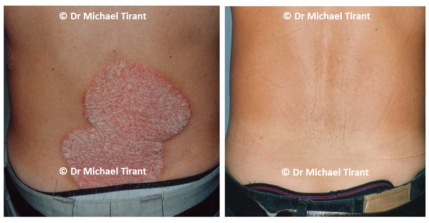 benh vay nen co tinh di truyen anh 2