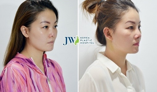 nâng mũi S-line đảm bảo ảnh 3 nang mui S-line dam bao anh 3