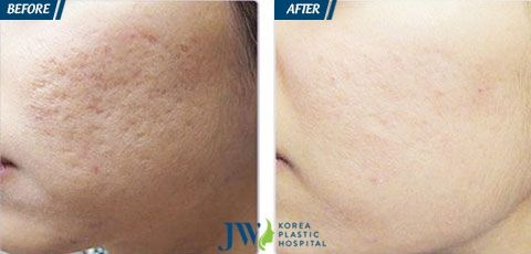 trị sẹo lõm tại bệnh viện thẩm mỹ JW Hàn Quốc ảnh 2 tri seo lom tai benh vien tham my JW Han Quoc anh 2