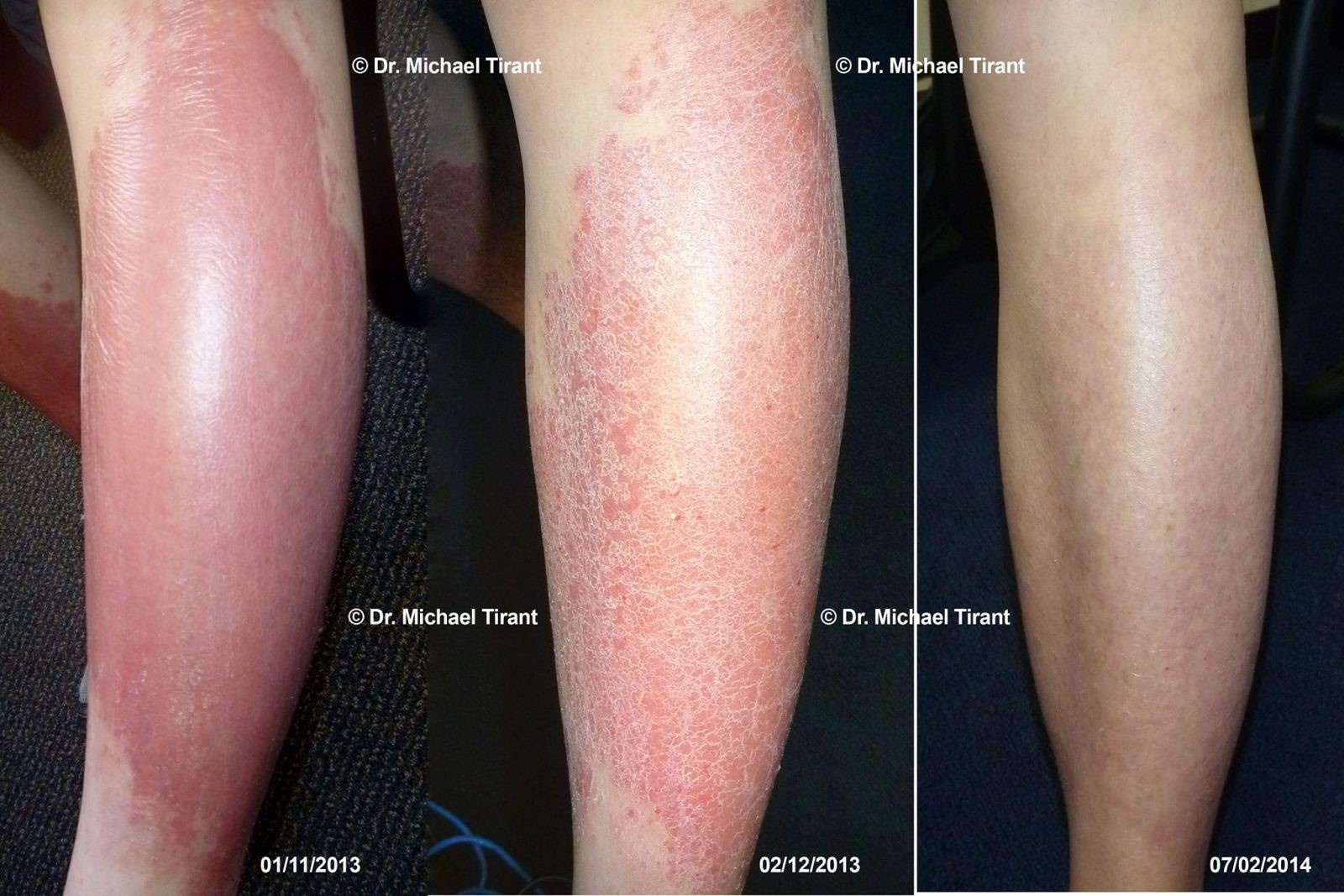 điều trị bệnh vảy nến bằng phương pháp Dr Michaels ảnh 3 dieu tri benh vay nen bang phuong phap Dr Michaels anh 3