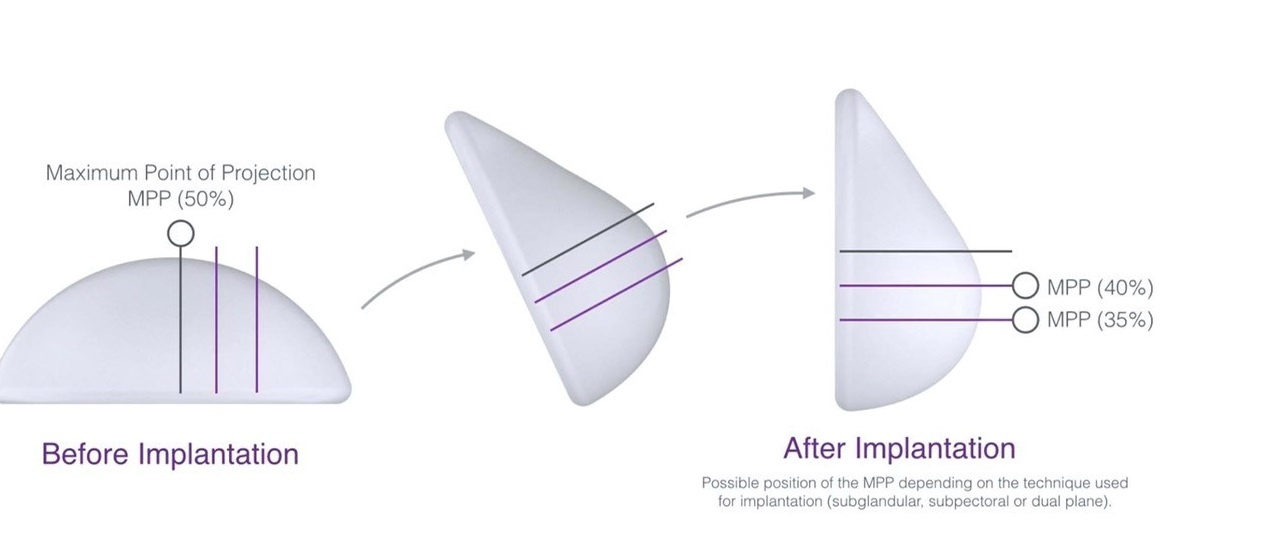 nang nguc Nanochip tai benh vien JW anh 2