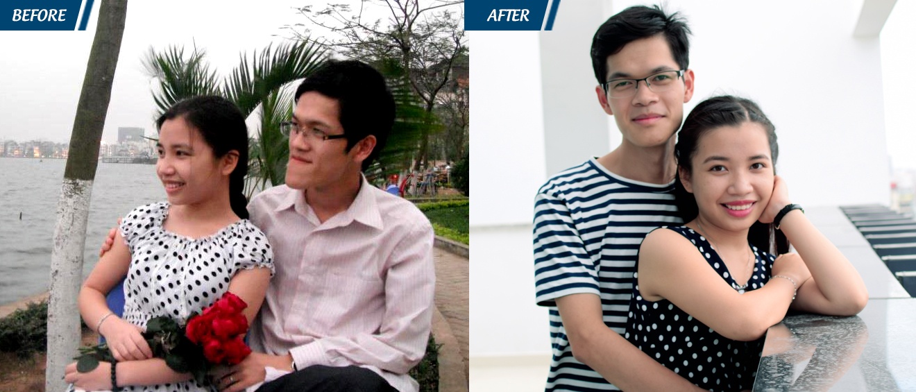 phẫu thuật hô móm tại JW ảnh 3 phau thuat ho mom tai JW anh 3