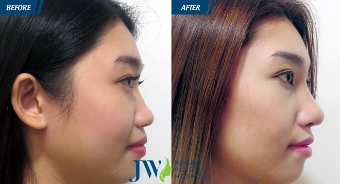 nang mui S-line tai JW anh 3