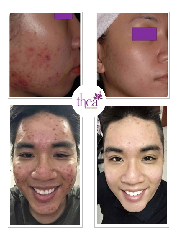 Thea Beauty Solutions giảm giá dịp hè ảnh 4 Thea Beauty Solutions giam gia dip he anh 4