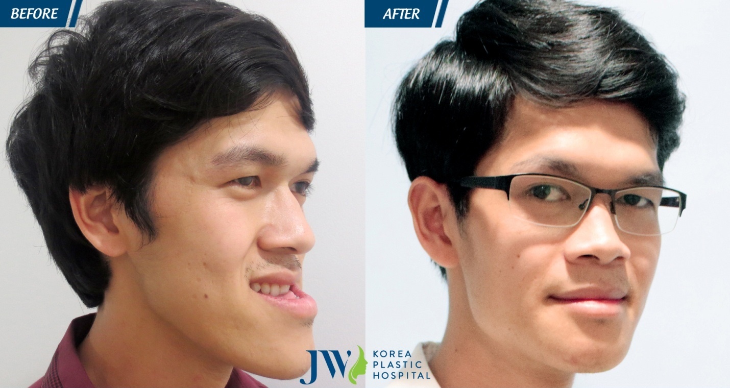 phẫu thuật hàm móm tại JW ảnh 1 phau thuat ham mom tai JW anh 1