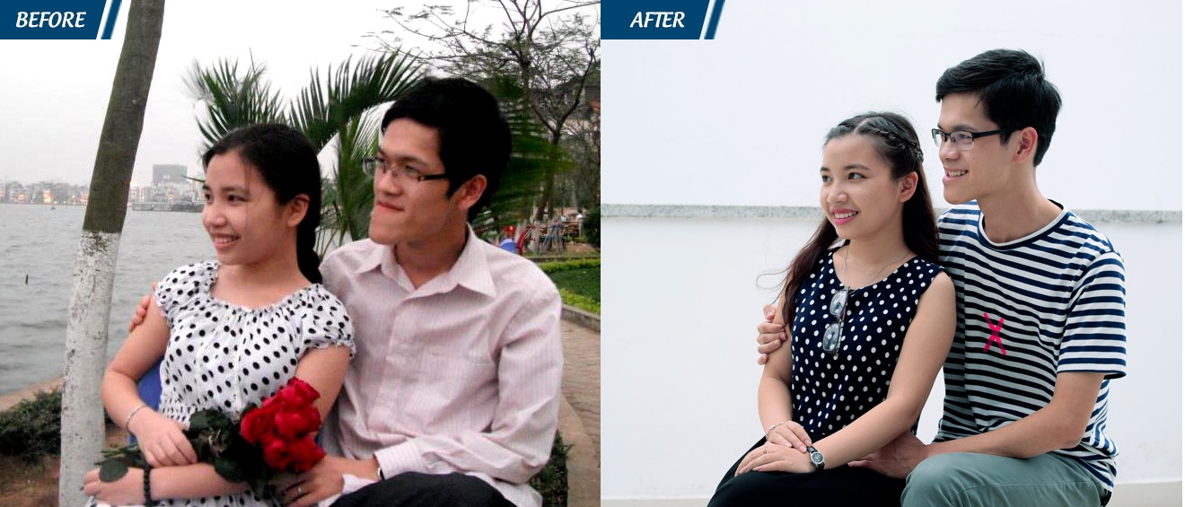 phẫu thuật hàm móm tại JW ảnh 2 phau thuat ham mom tai JW anh 2