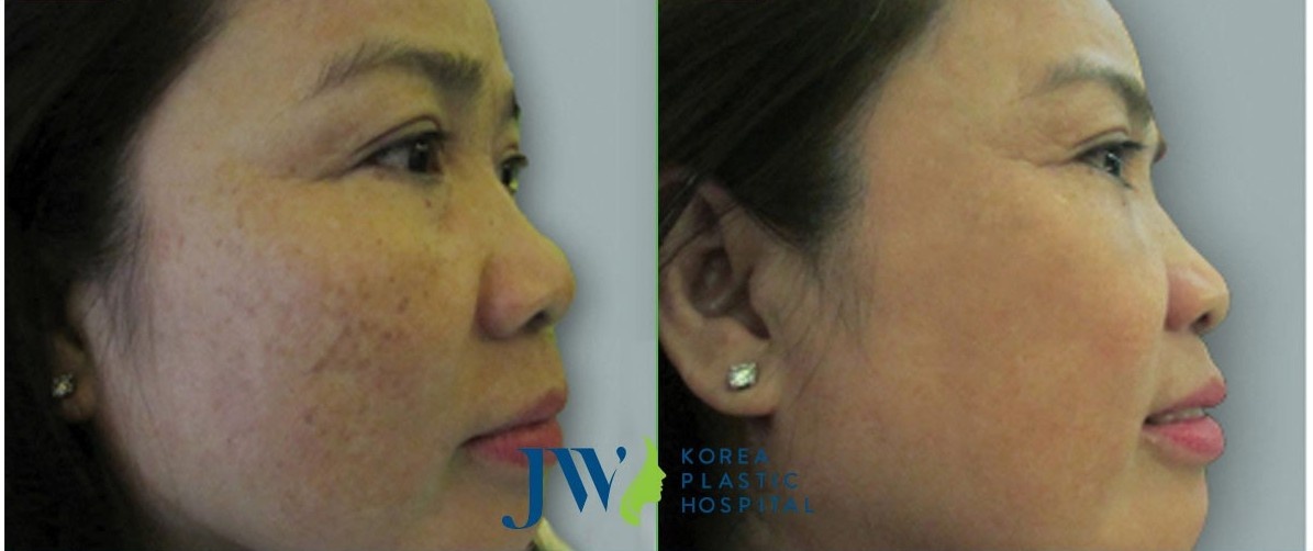 Trung tâm Skincare Bệnh viện thẩm mỹ JW Hàn Quốc ảnh 4 Trung tam Skincare Benh vien tham my JW Han Quoc anh 4