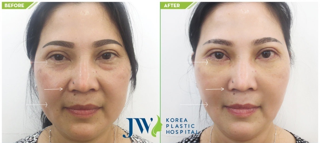 chuong trinh Tim lai tuoi xuan cho me cua JW anh 2