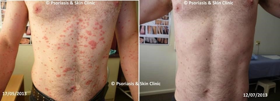 chua benh vay nen bang phuong phap Dr Michaels anh 2