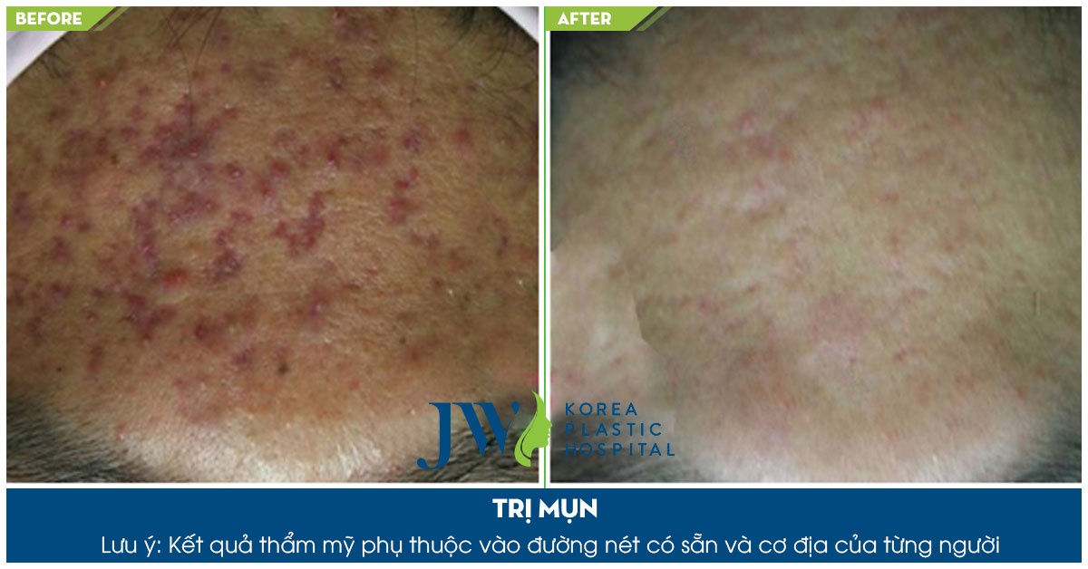 Benh vien tham my JW,  tri mun anh 3