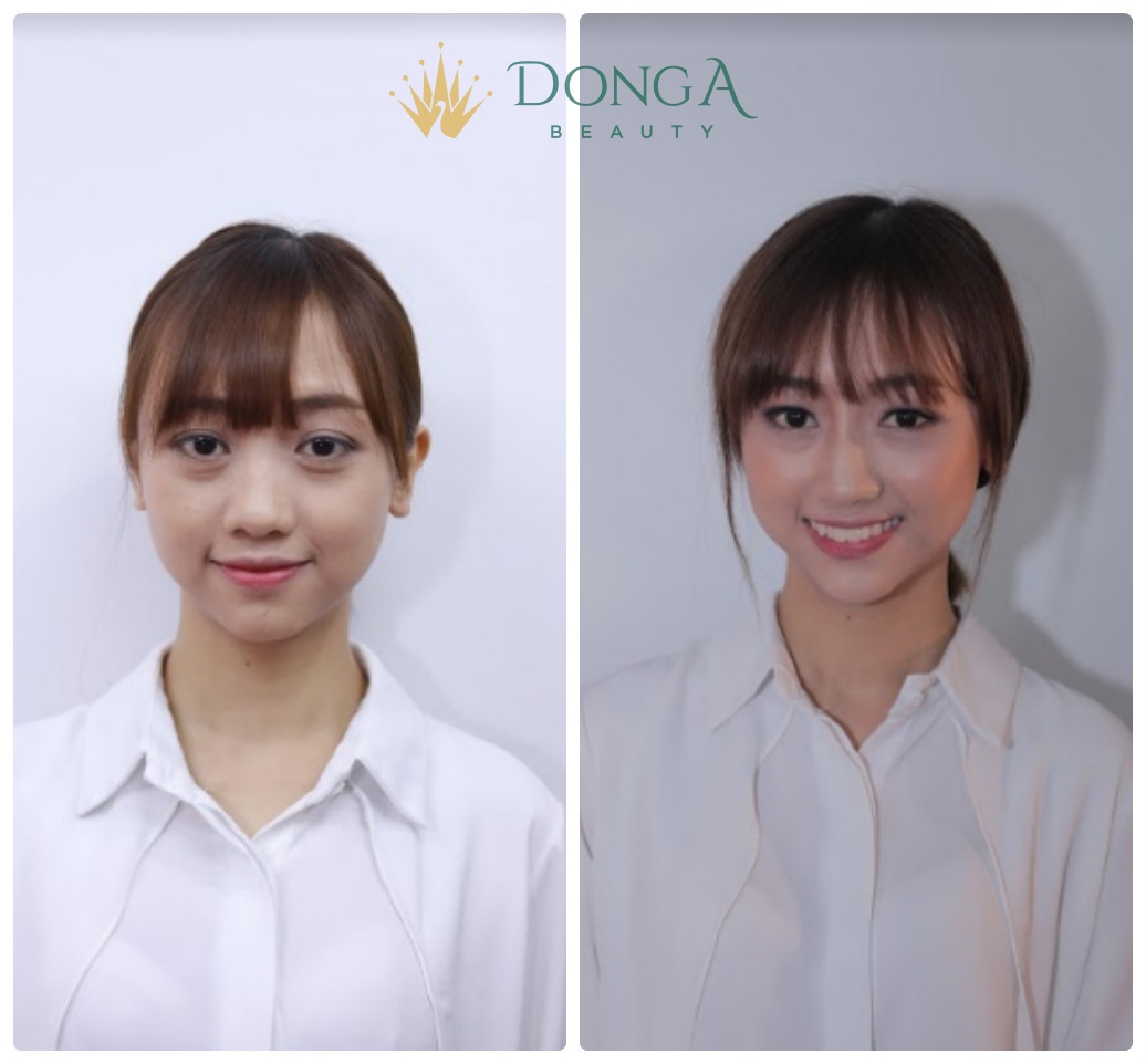 tham my khong phau thuat tai TMV Dong A anh 1