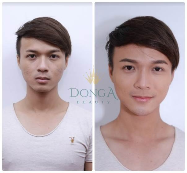 tham my khong phau thuat tai TMV Dong A anh 4