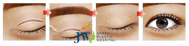 phau thuat cat mi tai JW anh 2