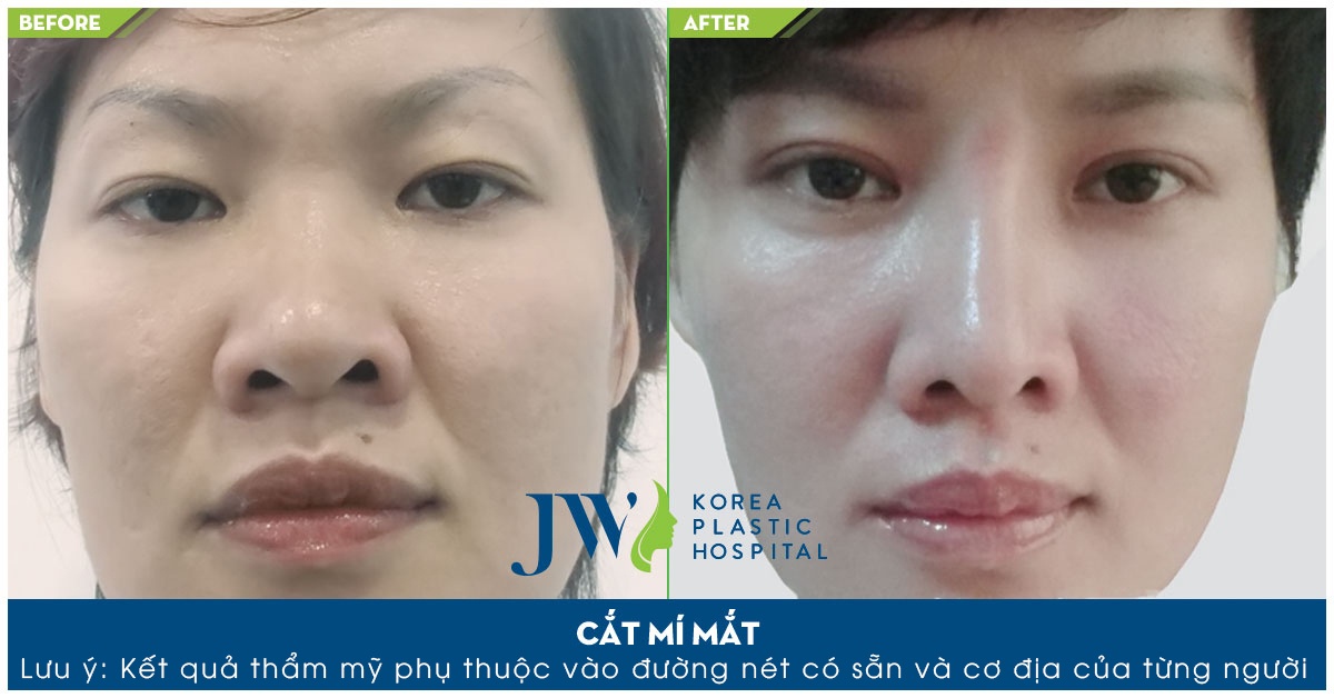 phau thuat cat mi tai JW anh 3