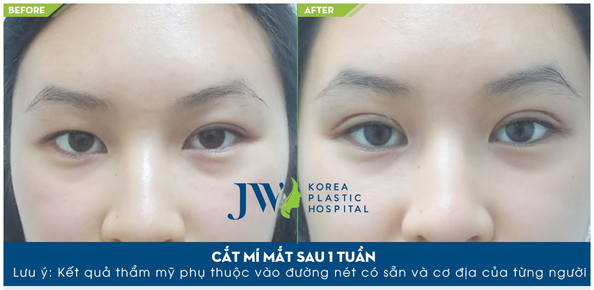 phau thuat cat mi tai JW anh 4