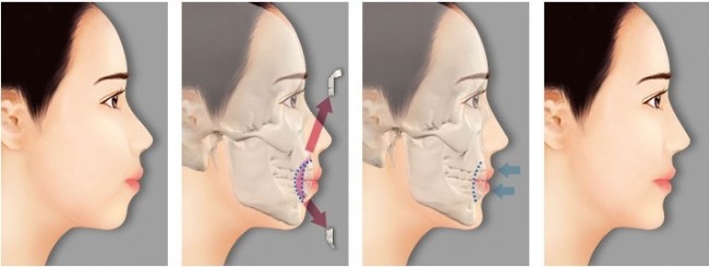 JW Hàn Quốc , phẫu thuật chỉnh hình ảnh 1 JW Han Quoc , phau thuat chinh hinh anh 1