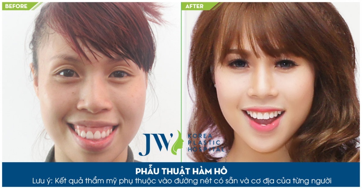 JW Hàn Quốc, nha khoa thẩm mỹ ảnh 2 JW Han Quoc, nha khoa tham my anh 2