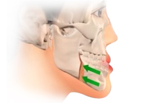 Phau thuat hai ham chinh ho mom toan dien tai JW hinh anh