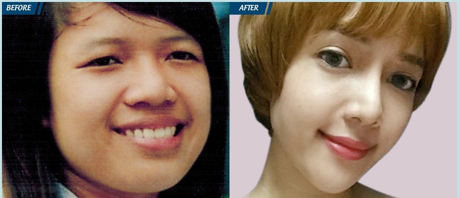 Gọt mặt V-line tại JW ảnh 1 Got mat V-line tai JW anh 1