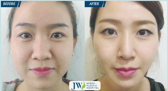 Gọt mặt V-line tại JW ảnh 2 Got mat V-line tai JW anh 2