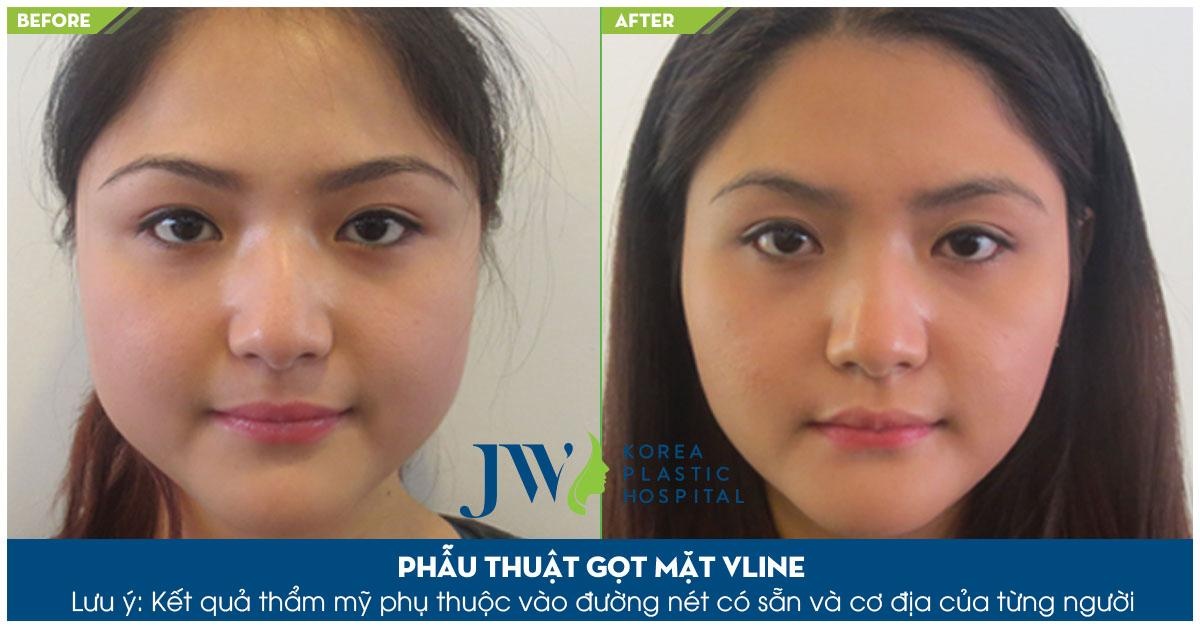 Bệnh viện thẩm mỹ JW Hàn Quốc chi nhánh Việt Nam ảnh 3 Benh vien tham my JW Han Quoc chi nhanh Viet Nam anh 3