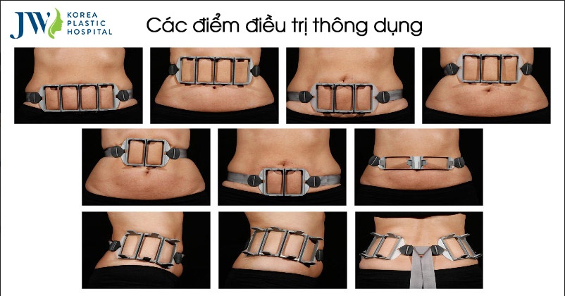 Benh vien tham my JW Han Quoc,  SculpSure anh 3