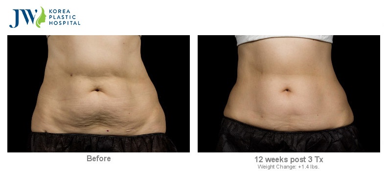 Benh vien tham my JW Han Quoc,  SculpSure anh 5