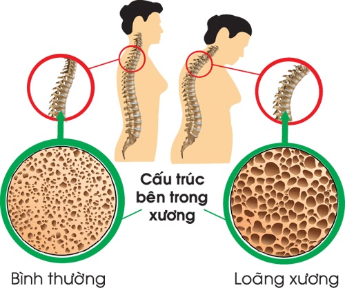 nước uống không an toàn dẫn đến loãng xương ảnh 1 nuoc uong khong an toan dan den loang xuong anh 1