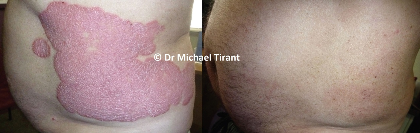 Phương pháp Dr Michaels , bệnh vảy nến ảnh 2 Phuong phap Dr Michaels , benh vay nen anh 2