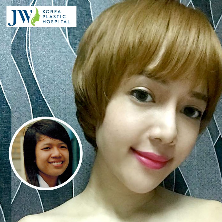 Bệnh viện thẩm mỹ JW Hàn Quốc, phẫu thuật thẩm mỹ ảnh 5 Benh vien tham my JW Han Quoc, phau thuat tham my anh 5