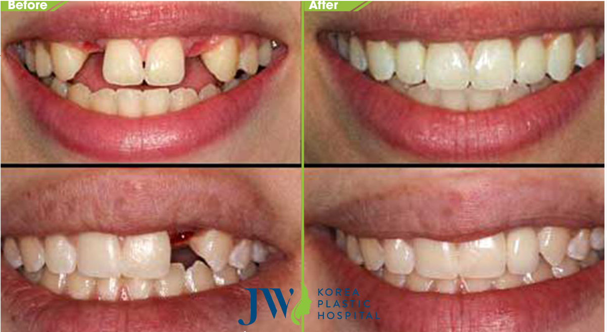 Benh vien tham my JW Han Quoc,  rang su anh 3