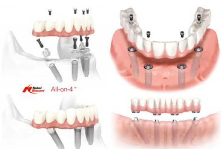Implant All on 4,  Bệnh viện Thẩm mỹ JW Hàn Quốc ảnh 2 Implant All on 4,  Benh vien Tham my JW Han Quoc anh 2