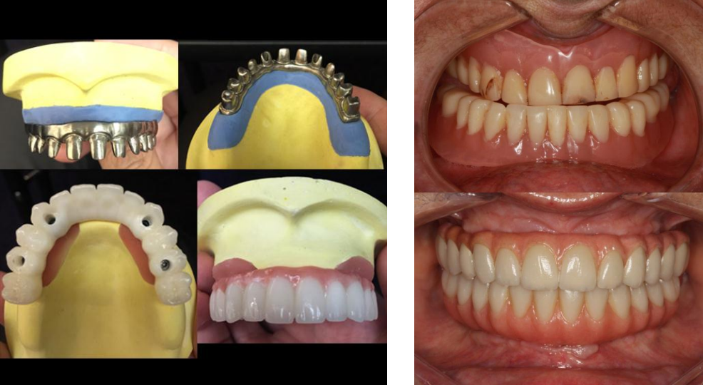 Implant All on 4,  Bệnh viện Thẩm mỹ JW Hàn Quốc ảnh 3 Implant All on 4,  Benh vien Tham my JW Han Quoc anh 3