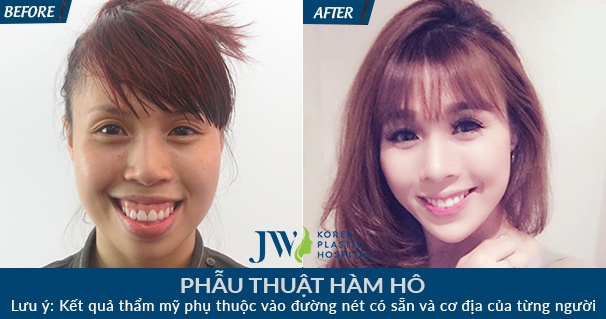 Bệnh viện Thẩm mỹ JW Hàn Quốc ảnh 2 Benh vien Tham my JW Han Quoc anh 2