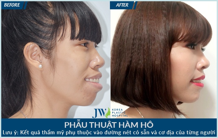 Bệnh viện Thẩm mỹ JW Hàn Quốc ảnh 6 Benh vien Tham my JW Han Quoc anh 6