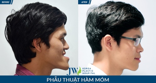 Benh vien Tham my JW Han Quoc,  khuyen mai anh 4