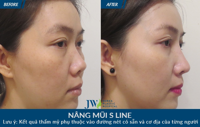 Bệnh viện JW Hàn Quốc, nâng mũi S-line ảnh 2 Benh vien JW Han Quoc, nang mui S-line anh 2