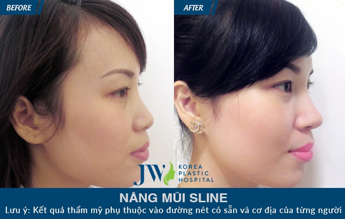 Bệnh viện JW Hàn Quốc, nâng mũi S-line ảnh 3 Benh vien JW Han Quoc, nang mui S-line anh 3