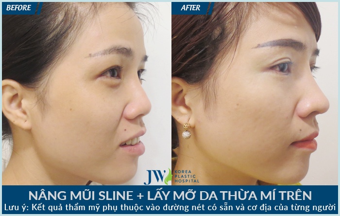 Bệnh viện JW Hàn Quốc, nâng mũi S-line ảnh 4 Benh vien JW Han Quoc, nang mui S-line anh 4