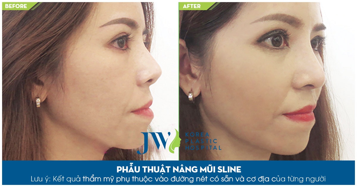 Bệnh viện JW Hàn Quốc, nâng mũi S-line ảnh 5 Benh vien JW Han Quoc, nang mui S-line anh 5