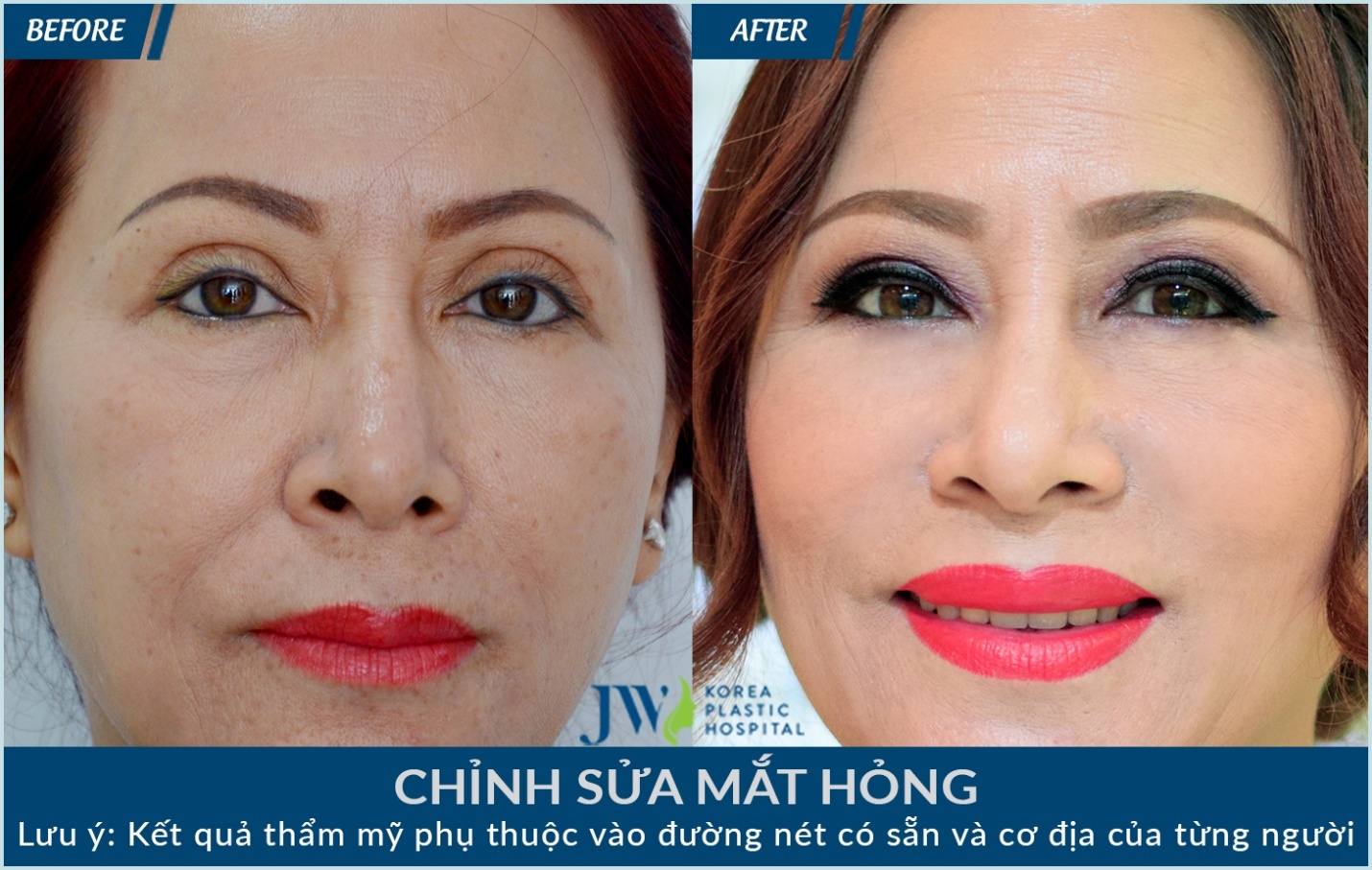 Tam su xuc dong cua nhung 'nan nhan' phau thuat tham my hong hinh anh