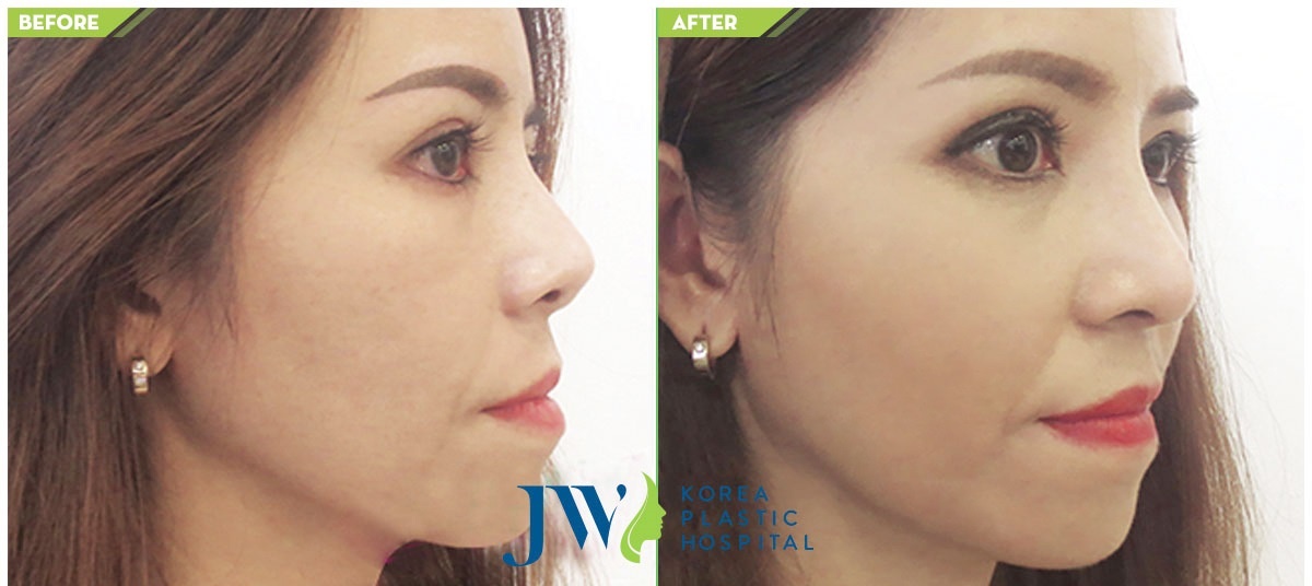 Bệnh viện thẩm mỹ JW Hàn Quốc ảnh 1 Benh vien tham my JW Han Quoc anh 1