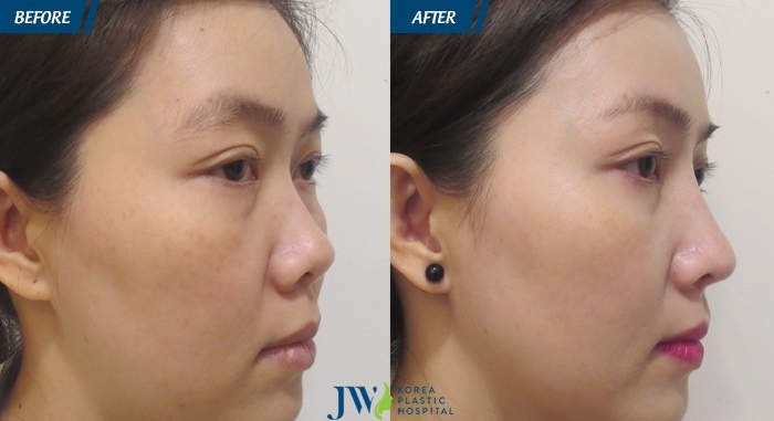 Bệnh viện thẩm mỹ JW Hàn Quốc ảnh 3 Benh vien tham my JW Han Quoc anh 3