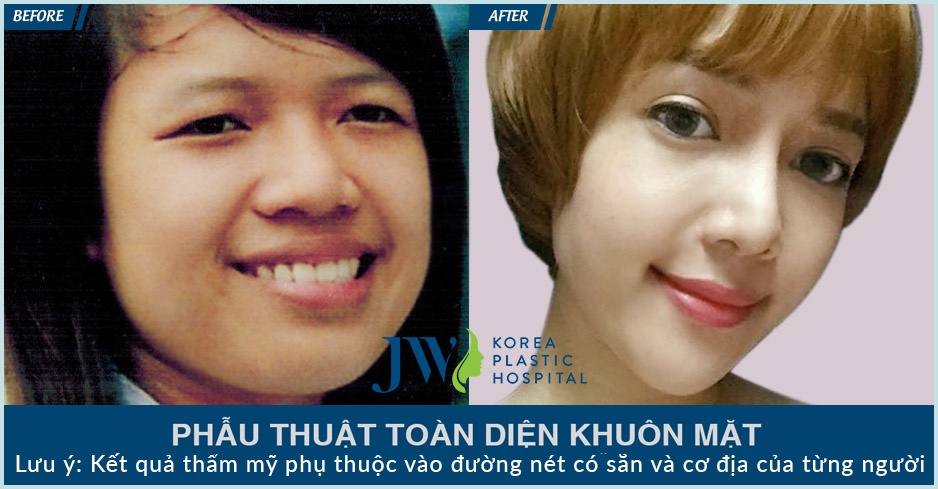 Bệnh viện Thẩm mỹ JW Hàn Quốc ảnh 1 Benh vien Tham my JW Han Quoc anh 1